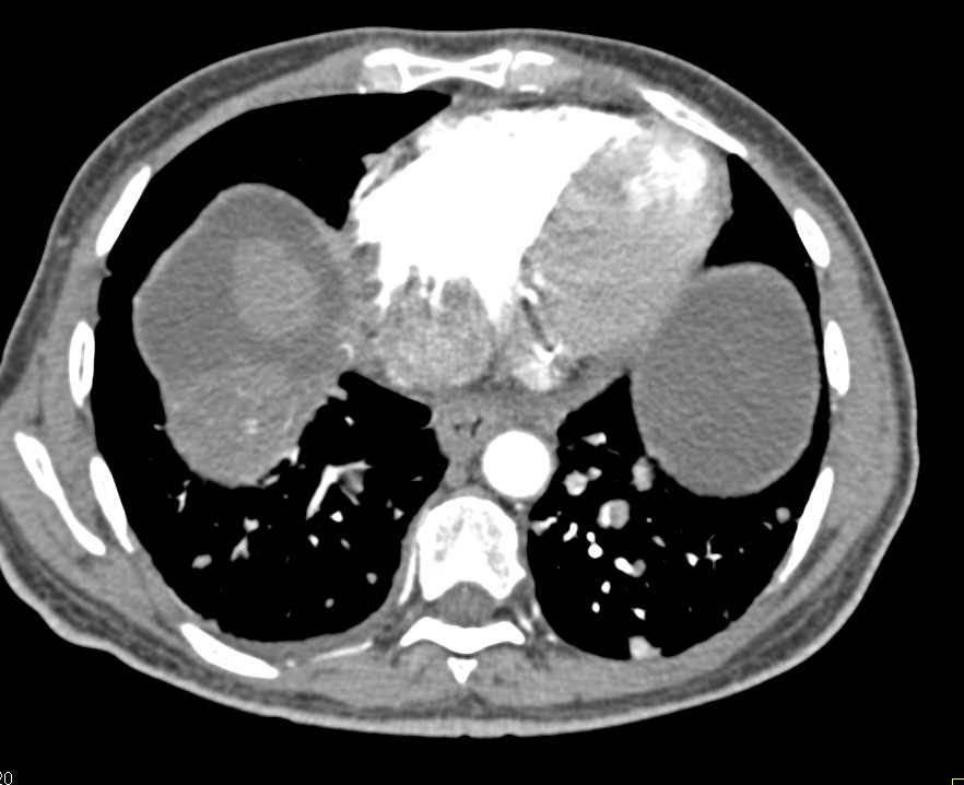 Cirrhosis with Portal Hypertension and PV/SMV Clot - CTisus CT Scan