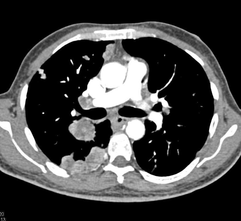 Hepatocellular Carcinoma (Hepatoma) Invades Portal Vein (PV) and Superior Mesenteric Vein (SMV) and Inferior Vena Cava (IVC) - CTisus CT Scan