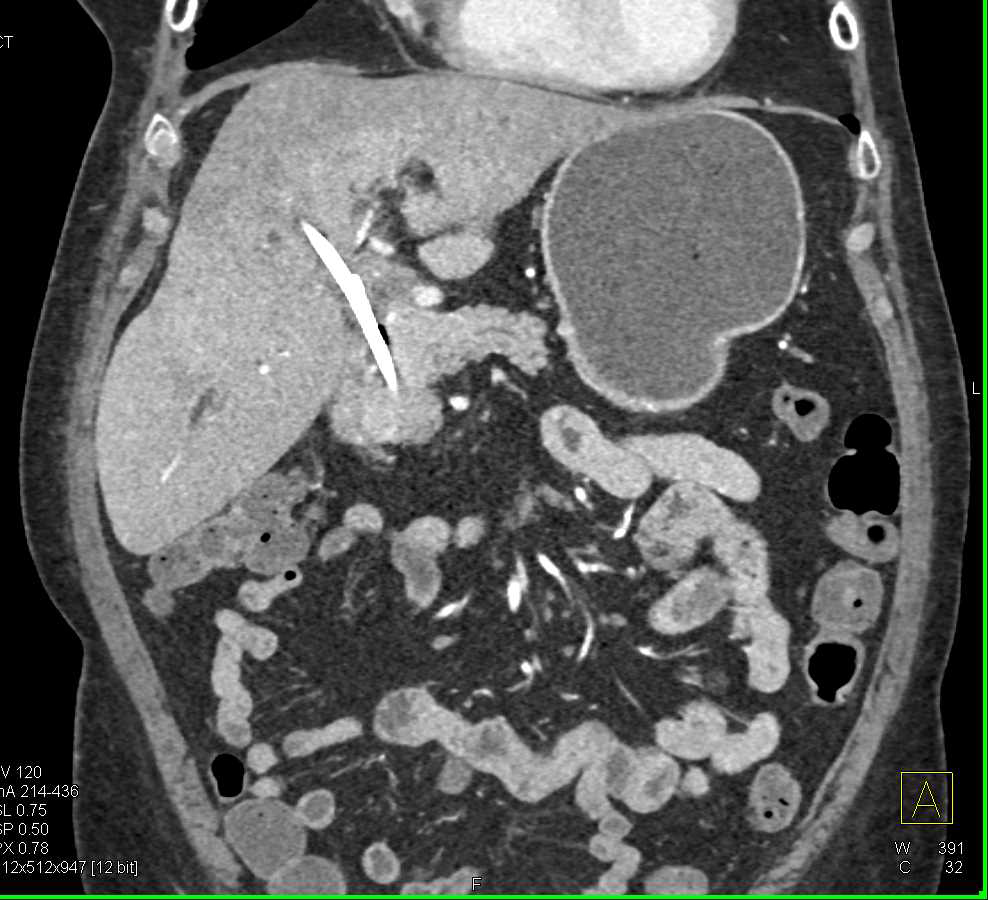 Distal Common Bile Duct Cancer with Stent and Liver Perfusion Changes - CTisus CT Scan