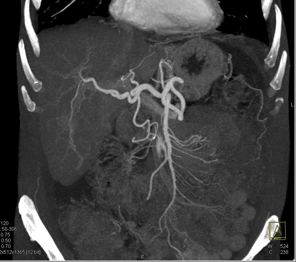 Cholangiocarcinoma - CTisus CT Scan