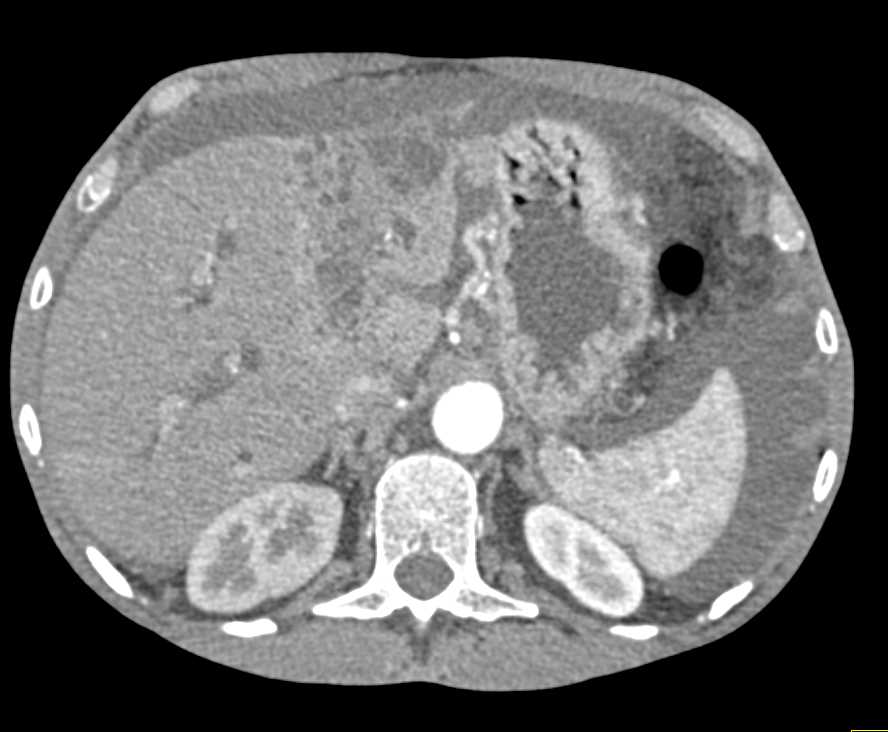 Cholangiocarcinoma with Central Infiltration - CTisus CT Scan