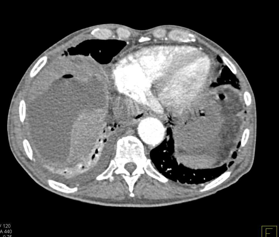 Multiple Liver Abscess with Pneumobilia and Gastric Emphysema - CTisus CT Scan