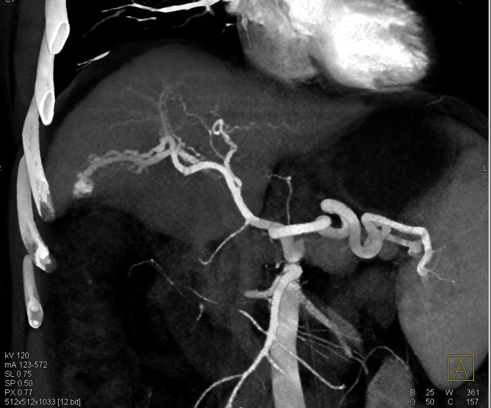 Cirrhosis Liver with Arteriovenous (AV) Shunting - CTisus CT Scan