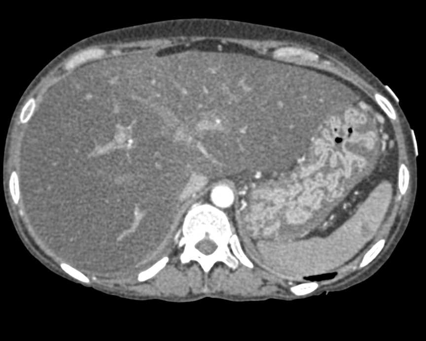 Fatty Infiltration of the Liver with Gastritis and Colitis - CTisus CT Scan