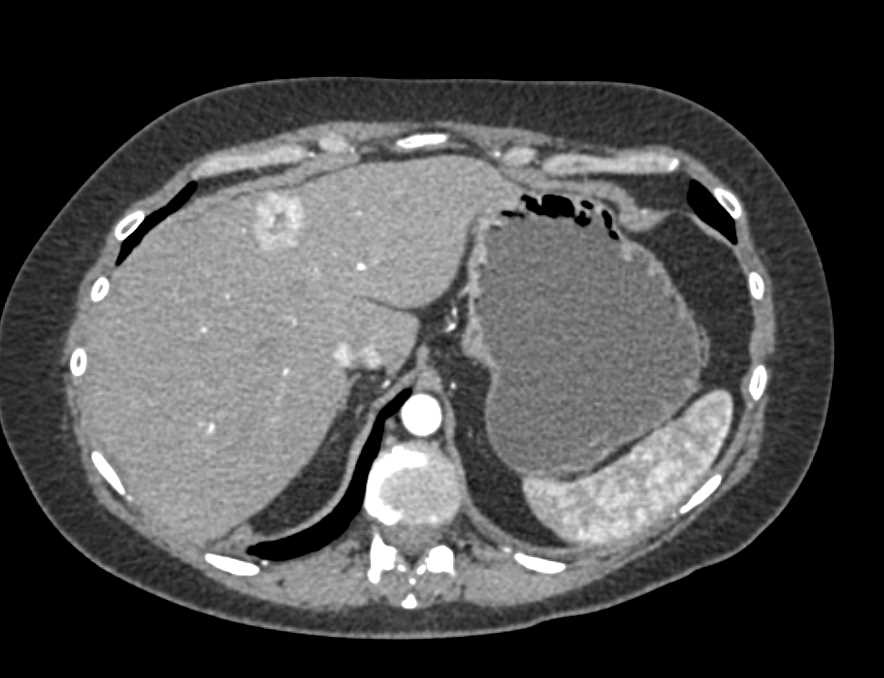 Vascular Liver Lesion is Focal Nodular Hyperplasia - CTisus CT Scan