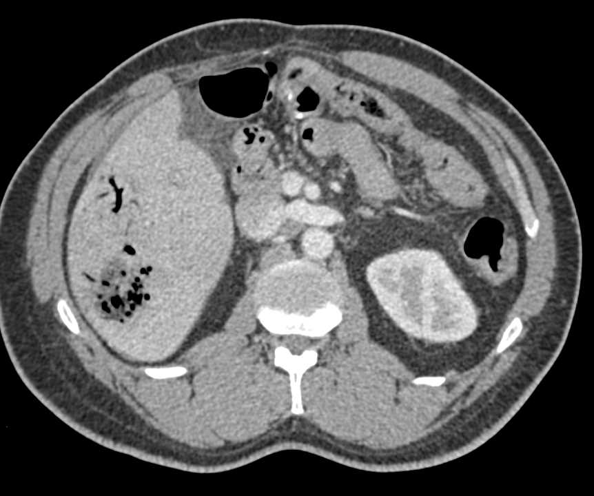 Liver Abscess in a Post Operative Patient - CTisus CT Scan