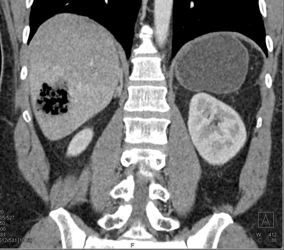 Liver Abscess in a Post Operative Patient - CTisus CT Scan