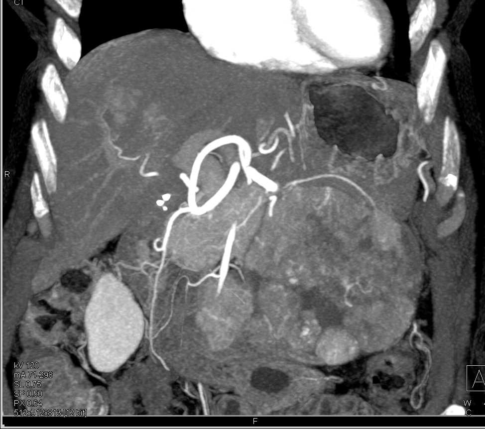 Liver Metastases from a Pancreatic Neuroendocrine Tumor - CTisus CT Scan