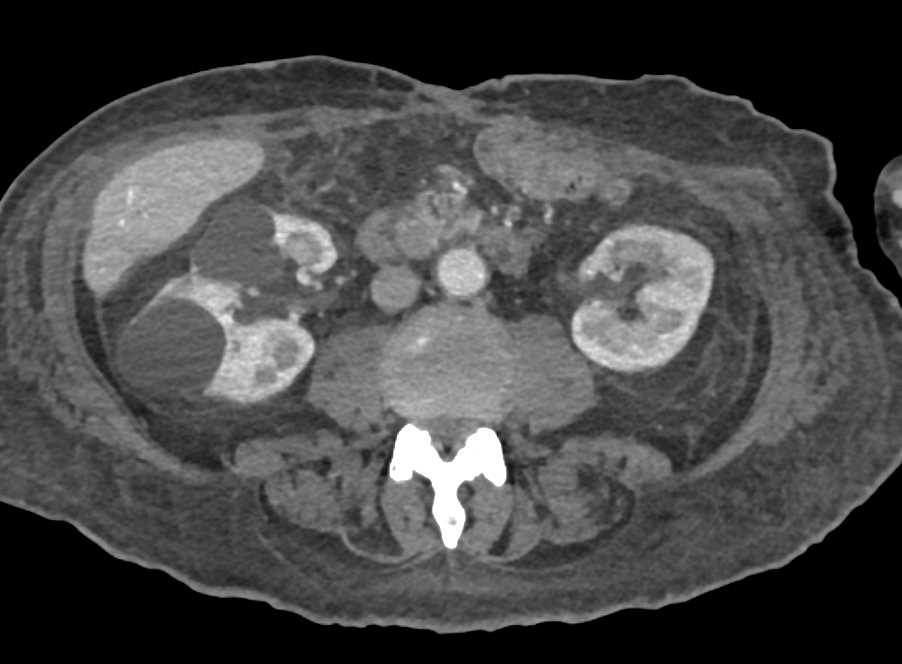 Impacted Stone in the Distal Common Bile Duct - CTisus CT Scan