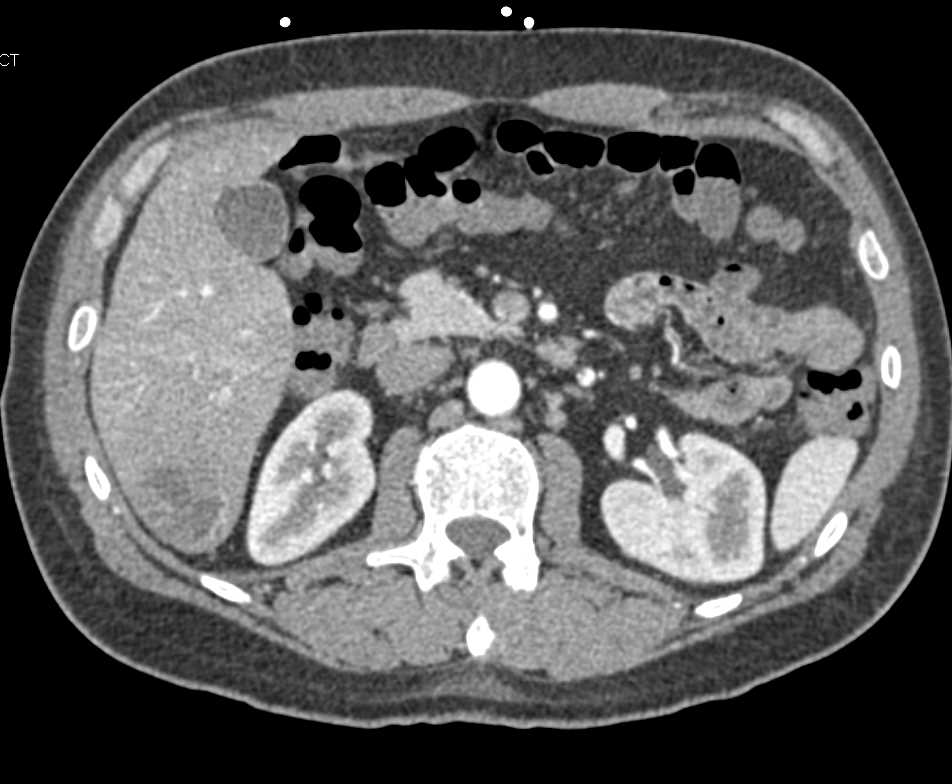 Liver Abscess in a Post Operative Patient - CTisus CT Scan