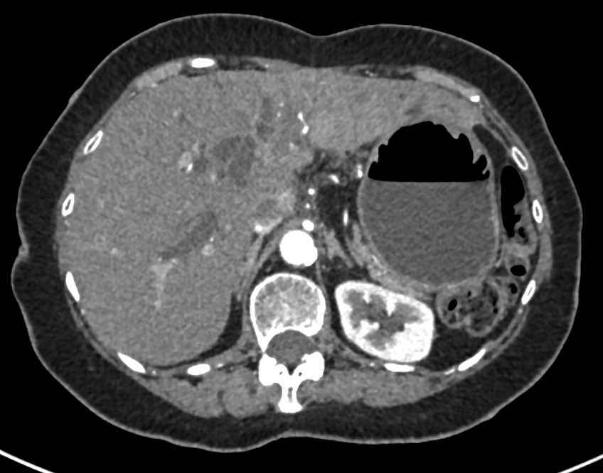 Cholangiocarcinoma with Central Infiltration and Dilated Ducts - CTisus CT Scan