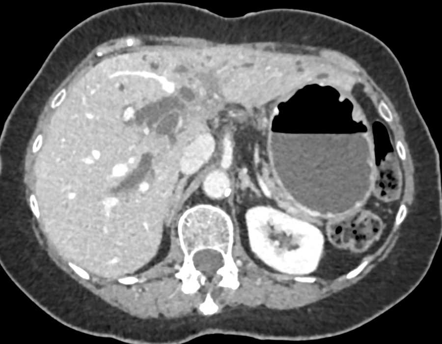 Cholangiocarcinoma with Central Infiltration and Dilated Ducts - CTisus CT Scan