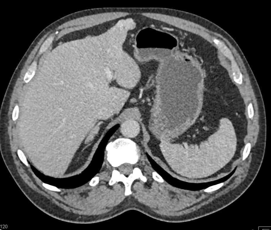 Atypical Hemangioma or Metastases to Liver - CTisus CT Scan