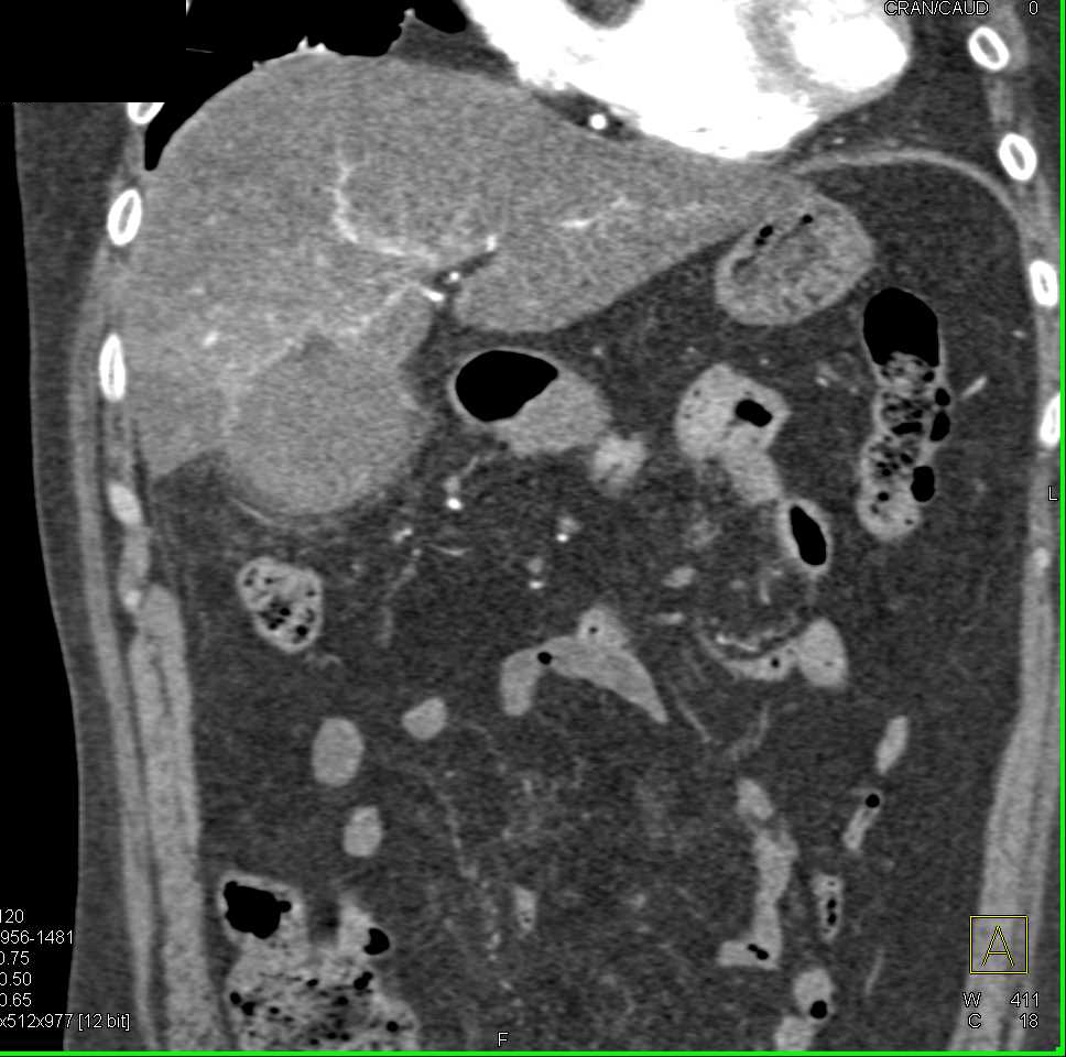 Acute Cholecystitis with RUQ Pain - CTisus CT Scan