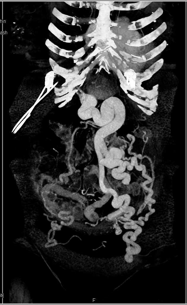 Huge Varices in Portal Hypertension Patient - CTisus CT Scan