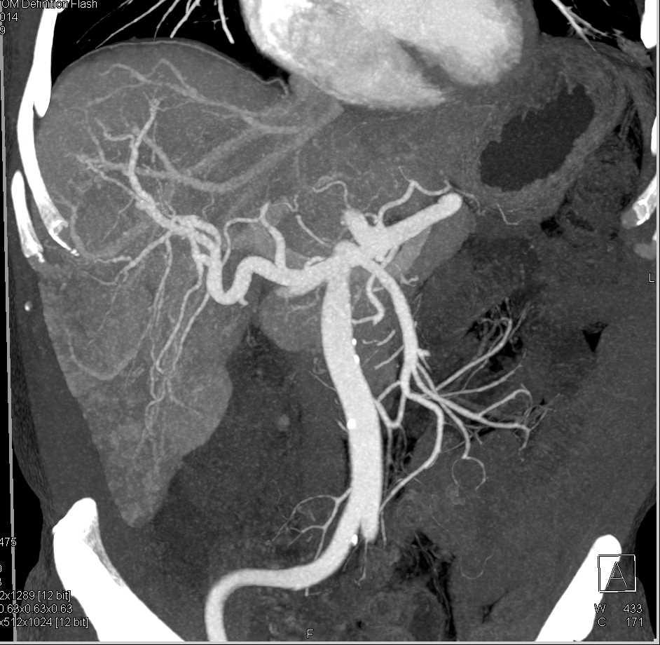 Arterial Mapping in a Cirrhotic Liver - CTisus CT Scan