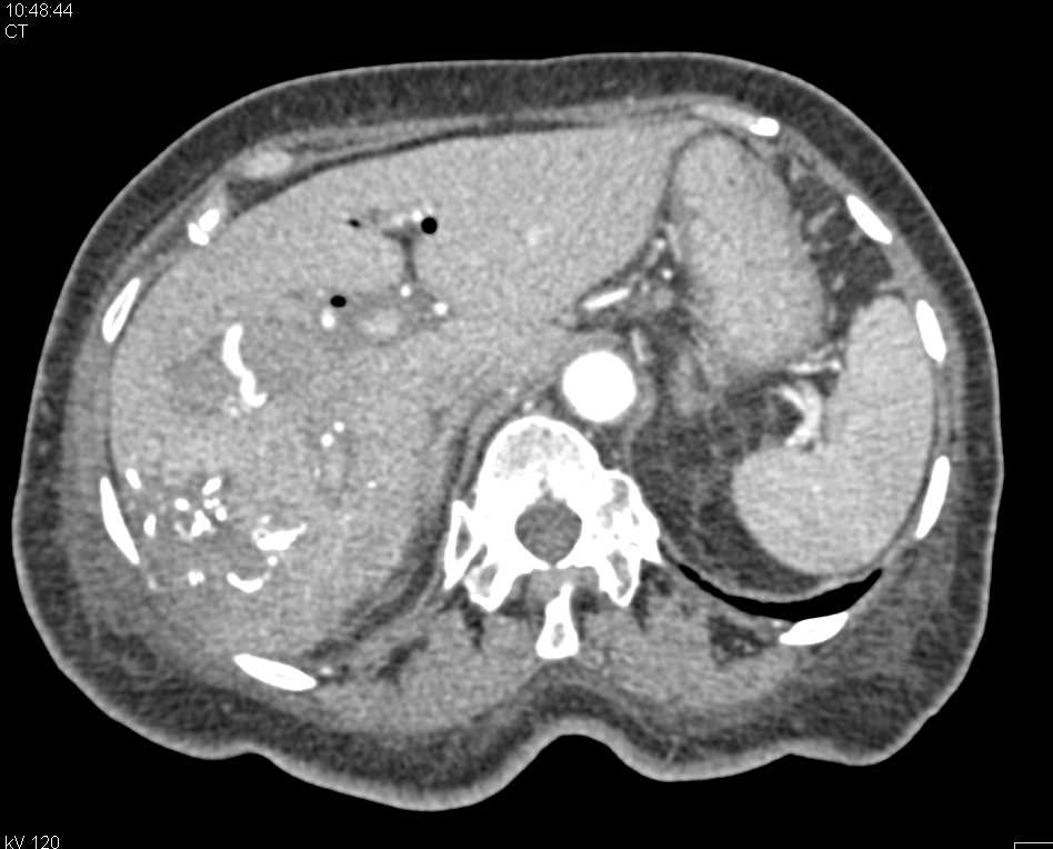 Hepatocellular Carcinoma (Hepatoma) with Chemoembolization - CTisus CT Scan