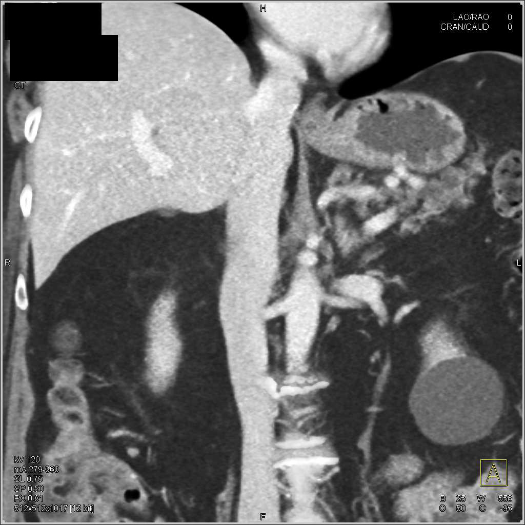 Ampullary Carcinoma with Dilated Common Bile Duct (CBD) - CTisus CT Scan