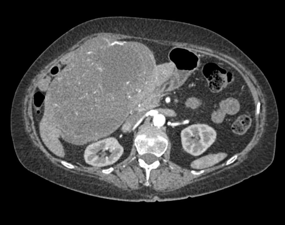 Fibrolamellar Hepatoma - CTisus CT Scan