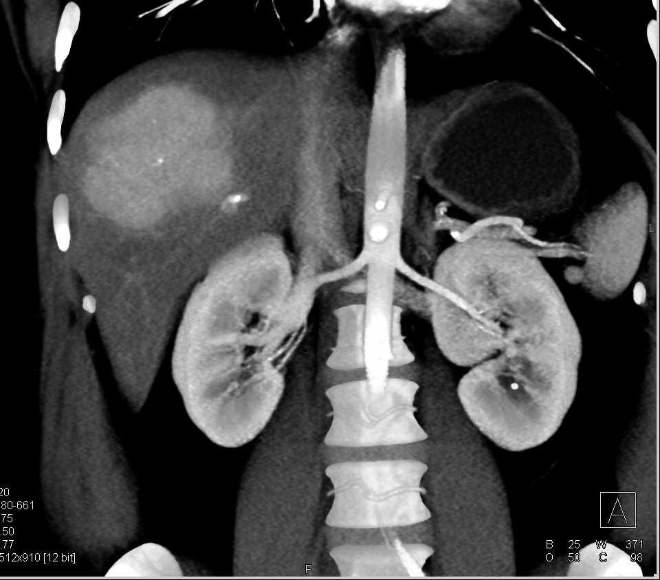 Focal Nodular Hyperplasia(FNH) Across Multiple Phases - CTisus CT Scan