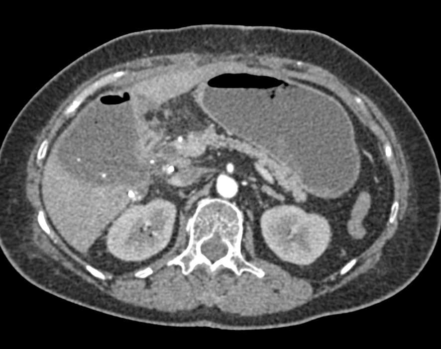 Abscess in the Gallbladder Fossa - CTisus CT Scan