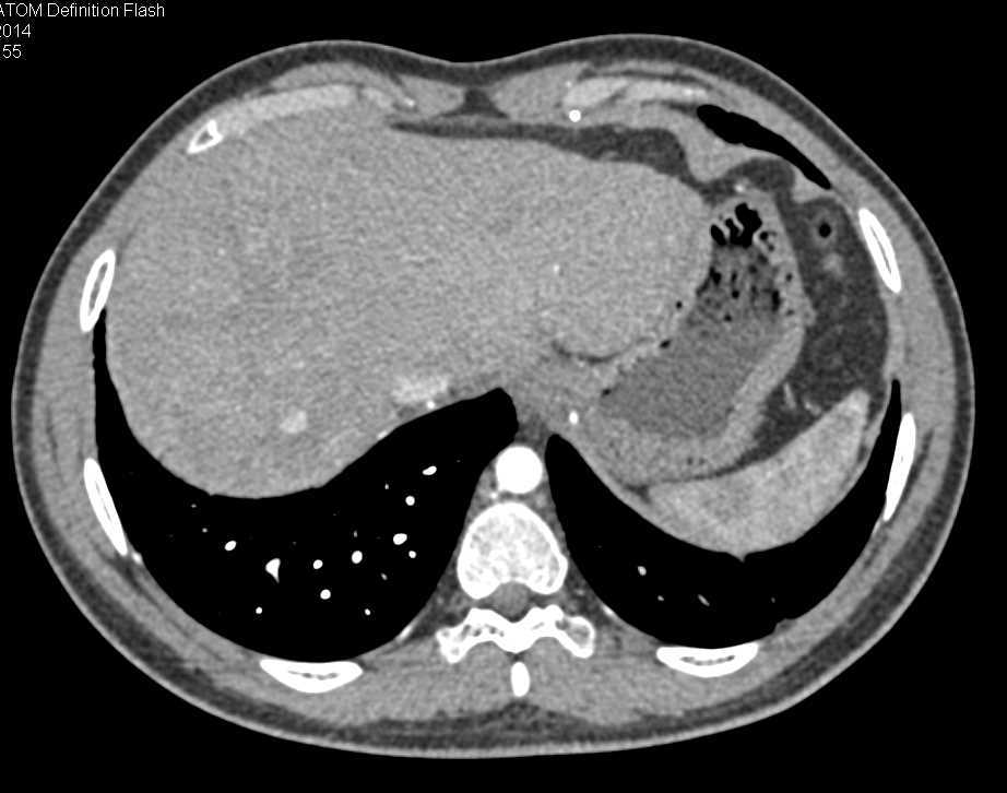 Metastatic Neuroendocrine Tumor to the Liver - CTisus CT Scan