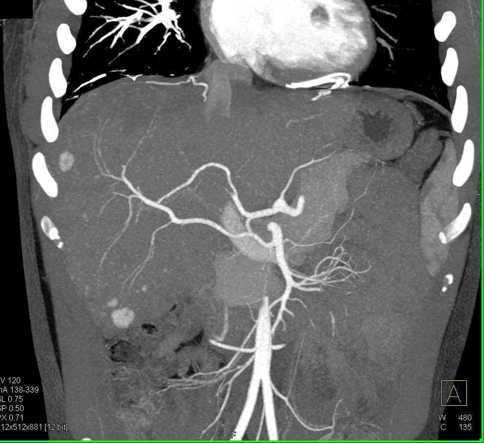 Metastatic Neuroendocrine Tumor to the Liver Best Seen on Arterial Phase Images - CTisus CT Scan