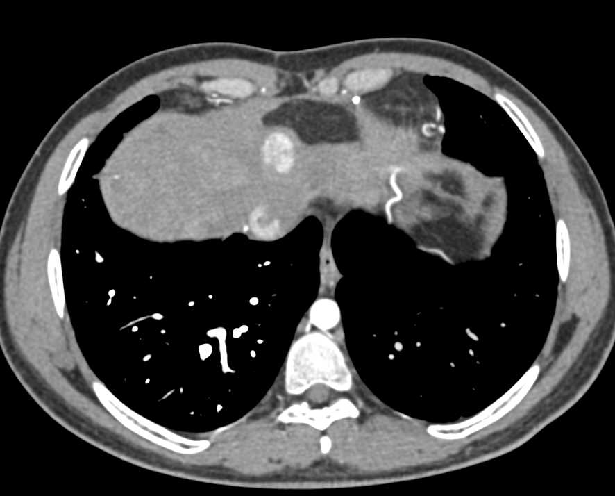 Metastatic Neuroendocrine Tumor to the Liver Best Seen on Arterial Phase Images - CTisus CT Scan