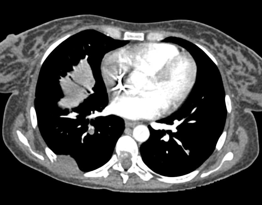 Liver and Lytic Bone Metastases - CTisus CT Scan