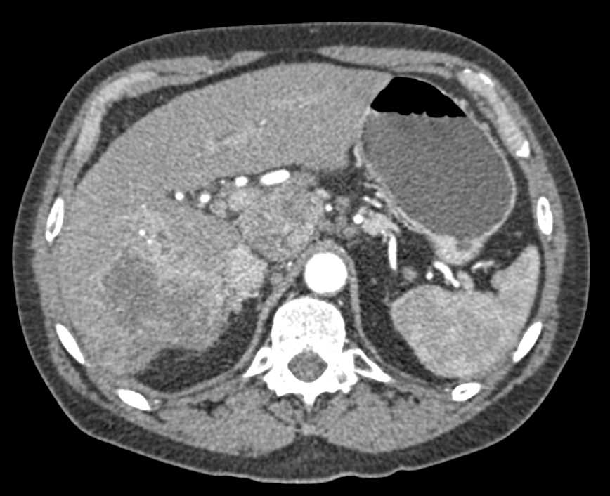 Cholangiocarcinoma Liver with Adenopathy in Porta Hepatis - CTisus CT Scan