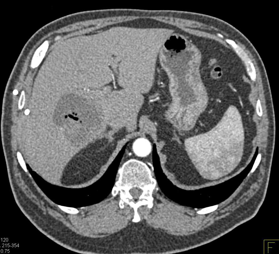 Liver Abscess - Liver Case Studies - CTisus CT Scanning