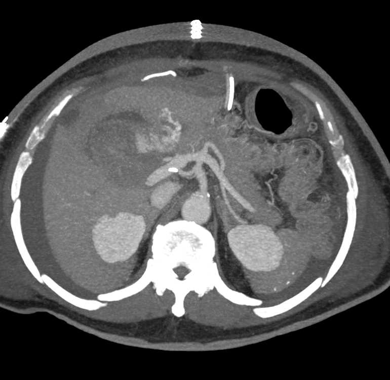 Hepatic Artery Bleed s/p Whipple Procedure - CTisus CT Scan