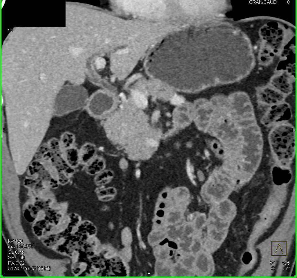 Thickened Common Bile Duct - CTisus CT Scan