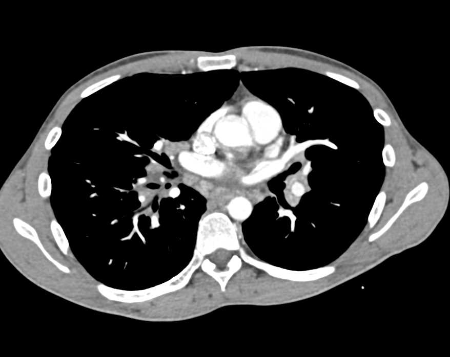 Multifocal Cholangiocrcinoma - CTisus CT Scan