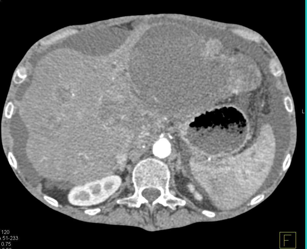 Central Cholangiocarcinoma with Vascular Invasion and Incidental Right Renal Cell Carcinoma - CTisus CT Scan