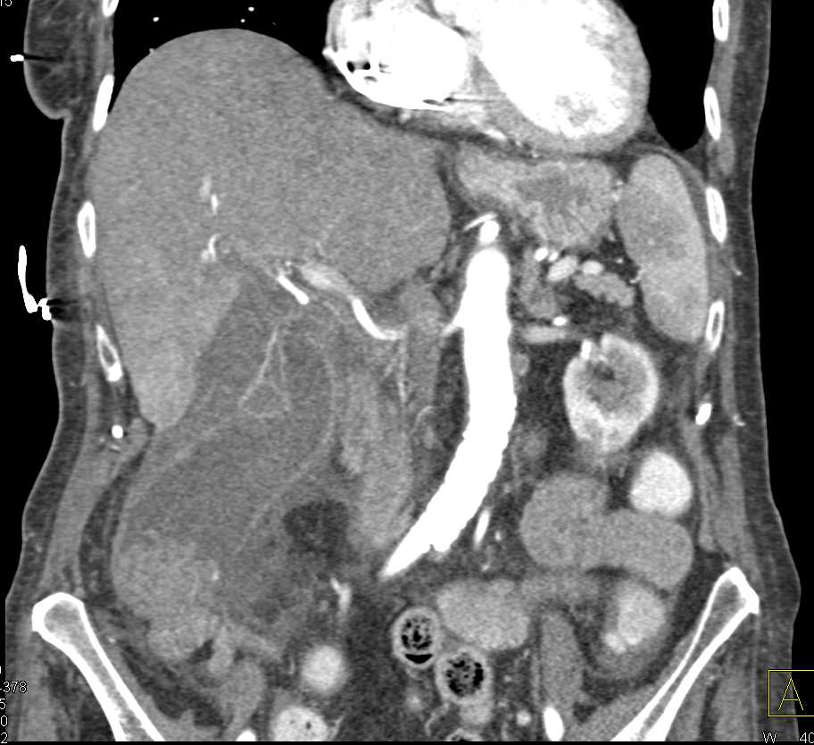 Ampullary Carcinoma with Dilated Common Bile Duct (CBD) - CTisus CT Scan