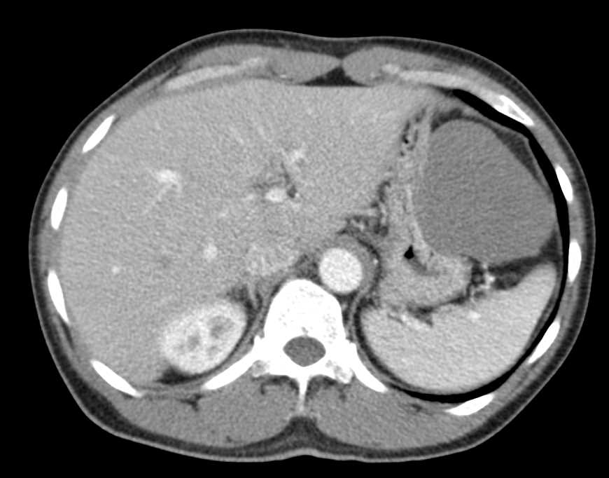 Hepatic Hemangioma is Exophytic in Location and Simulates a Gastric