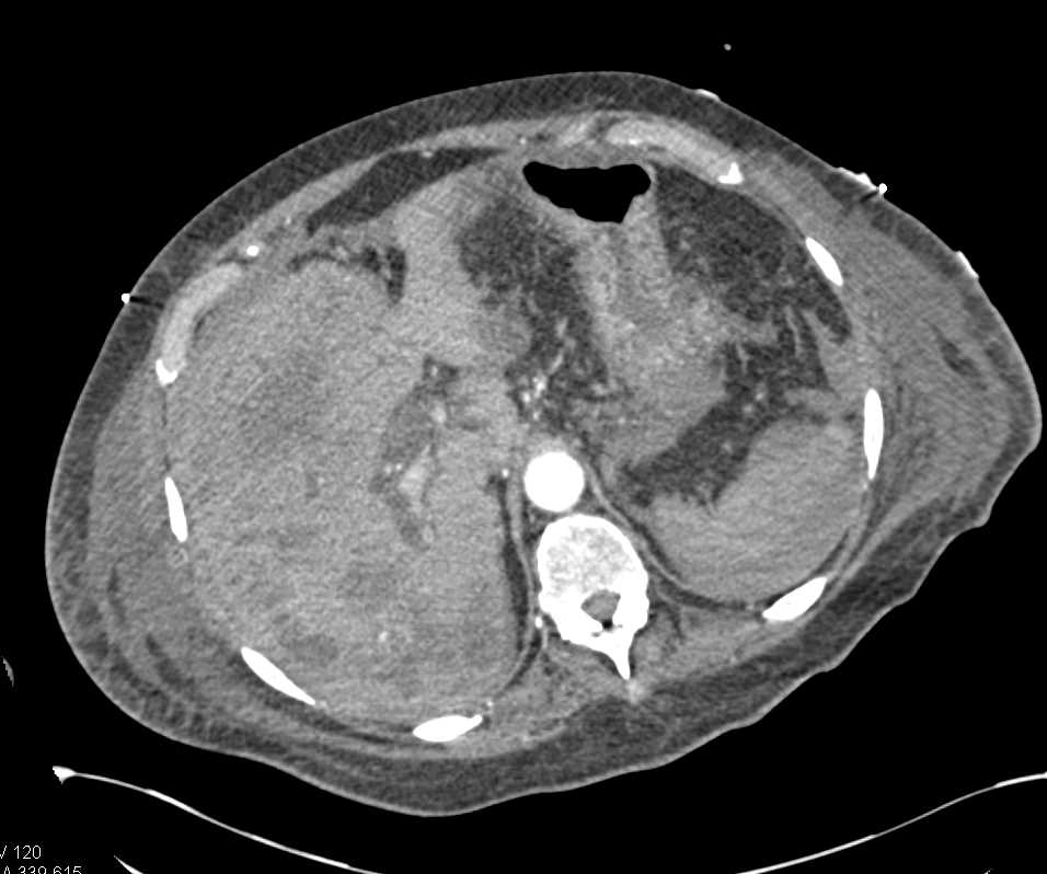 Intrahepatic Bleed and Hemoperitoneum S/P Trauma - CTisus CT Scan