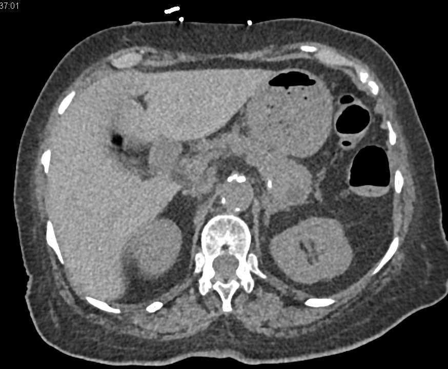 Pulmonary Embolism (PE) in Patient with Liver Metastases - CTisus CT Scan