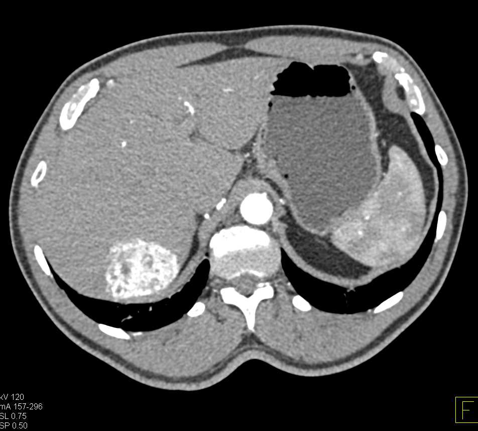 Hepatocellular Carcinoma (Hepatoma) with Neovascularity - CTisus CT Scan