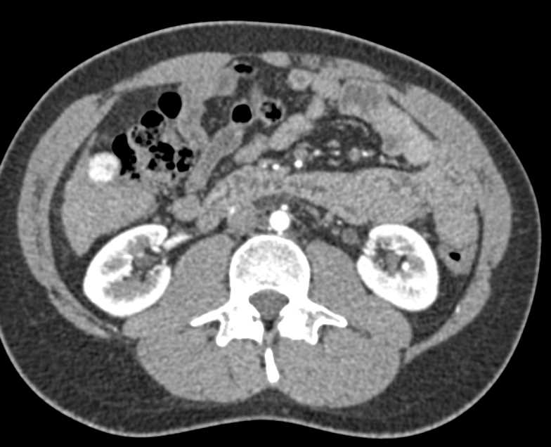 Multiple Regenerative Nodules Which Simulate Hepatocellular Carcinoma (Hepatoma) - CTisus CT Scan