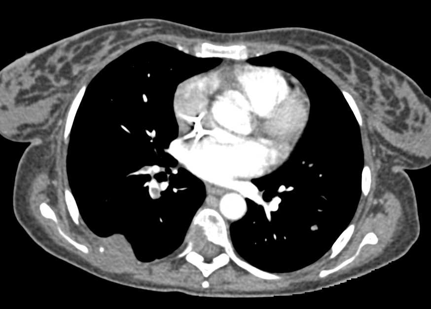 Hepatocellular Carcinoma (Hepatoma) with Multiple Bone Metastases and Incidental Pulmonary Emboli (PEs) - CTisus CT Scan