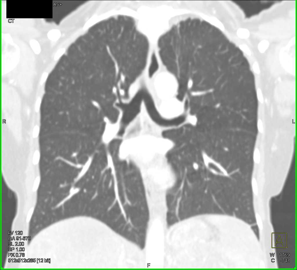 Left Upper Quadrant Sarcoma with Extensive Metastases - CTisus CT Scan