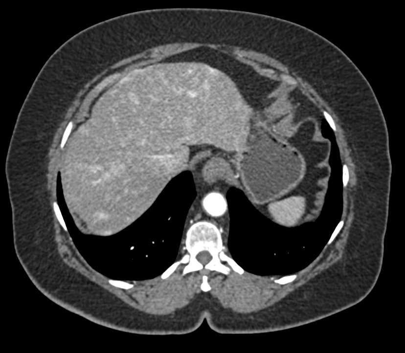 Metastatic Neuroendocrine Tumor to the Liver Best Seen on Arterial Phase Images - CTisus CT Scan