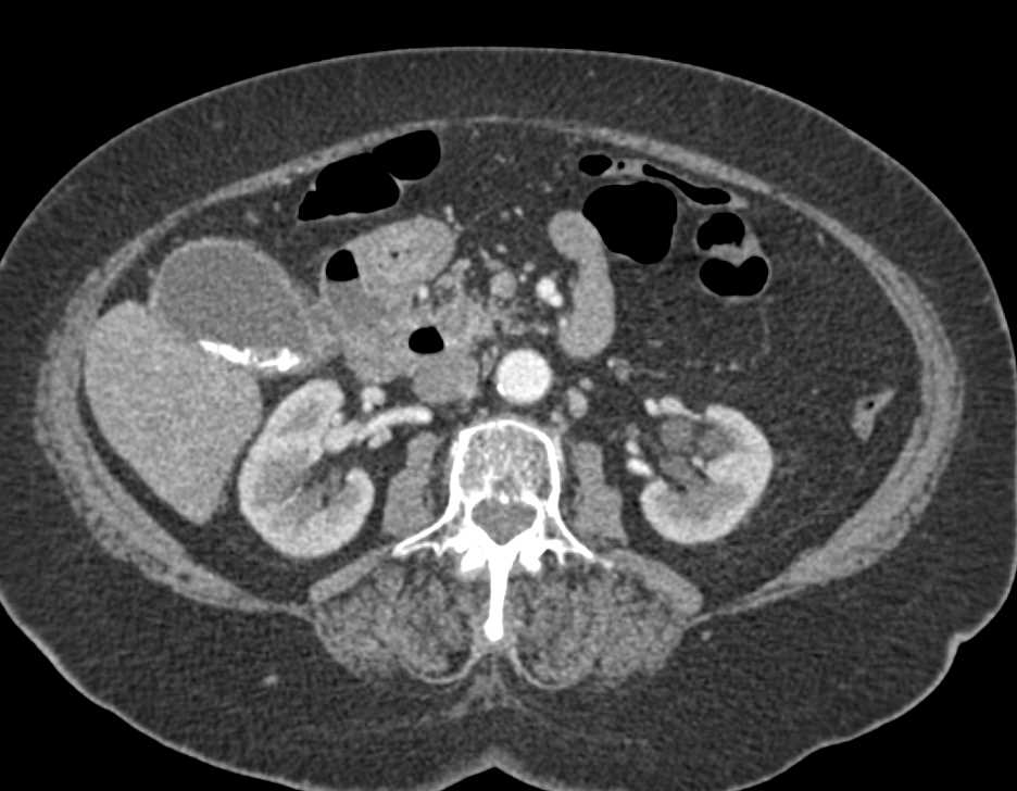 Obstructing Stone in Distal Common Bile Duct (CBD) with Mirizzi Syndrome - CTisus CT Scan