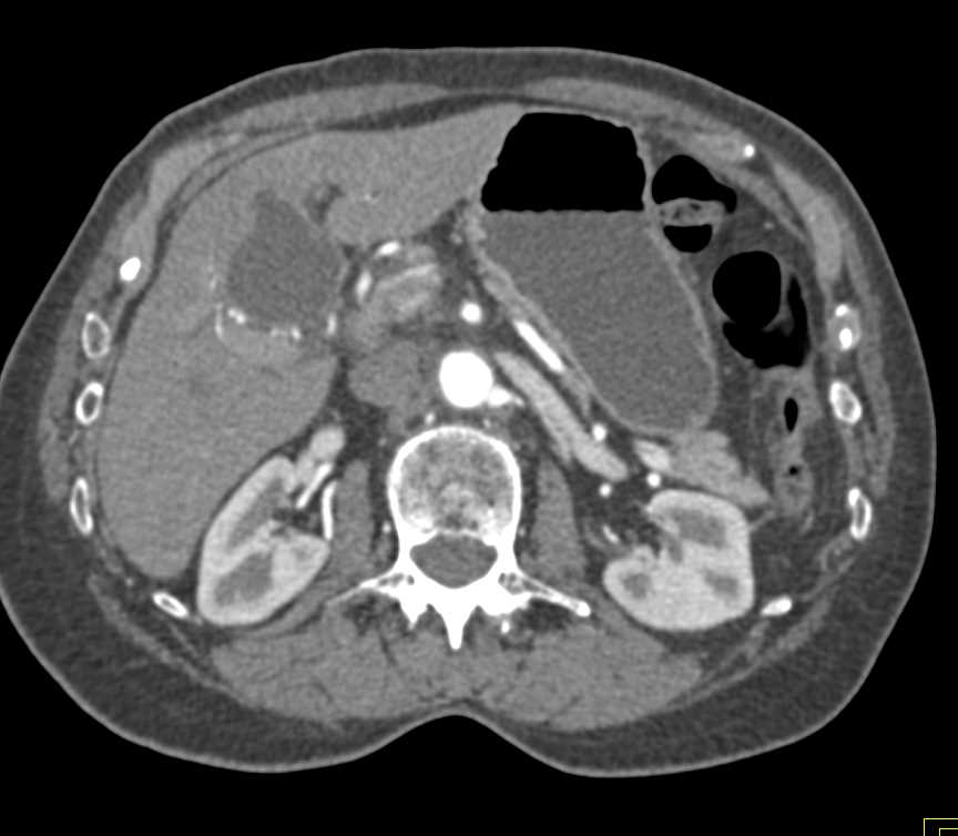 Central Cholangiocarcinoma - CTisus CT Scan