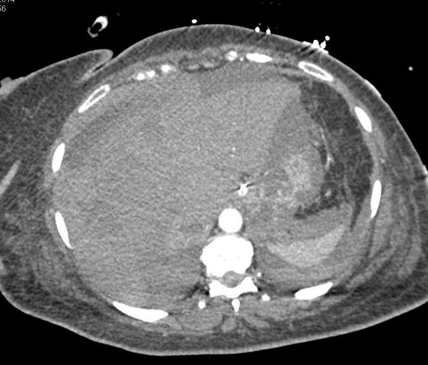 Intrahepatic and Perihepatic Bleed - CTisus CT Scan