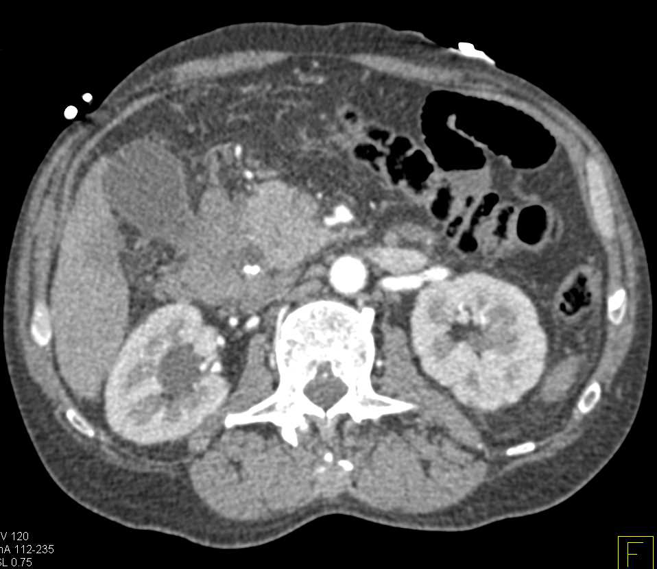 Distal Common Bile Duct Carcinoma - CTisus CT Scan