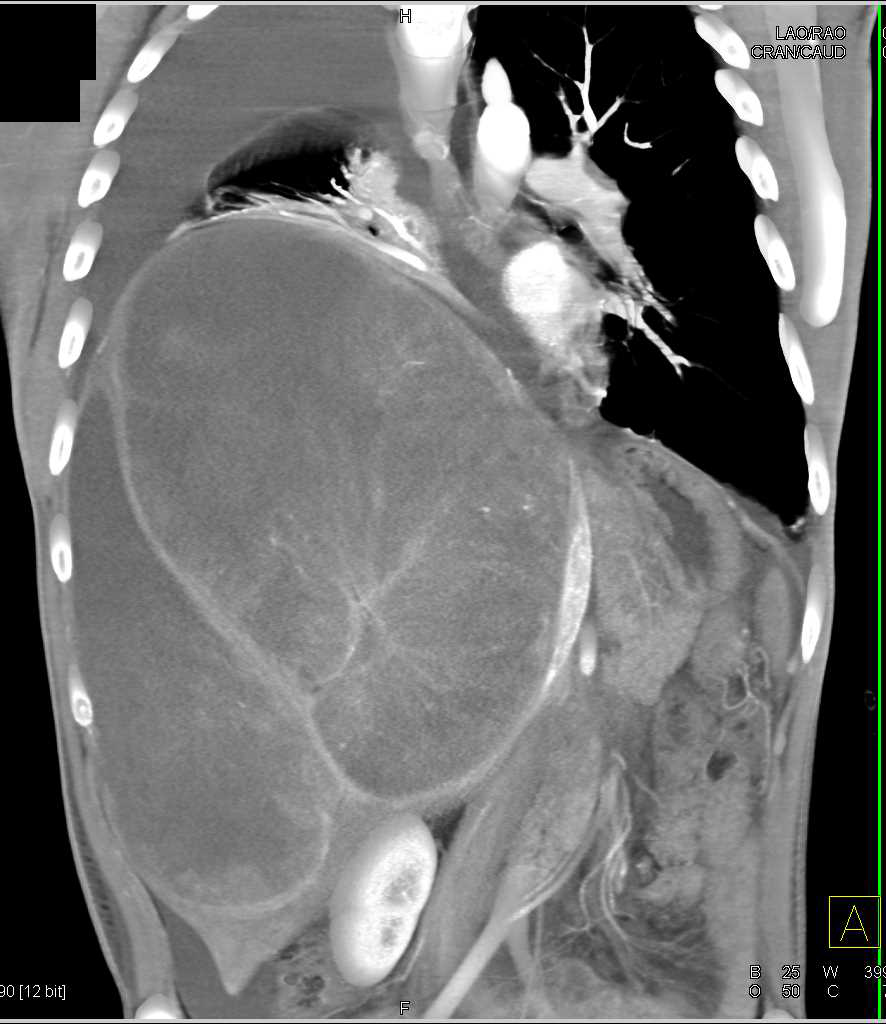 Spindle Cell Sarcoma Involves the Liver - CTisus CT Scan