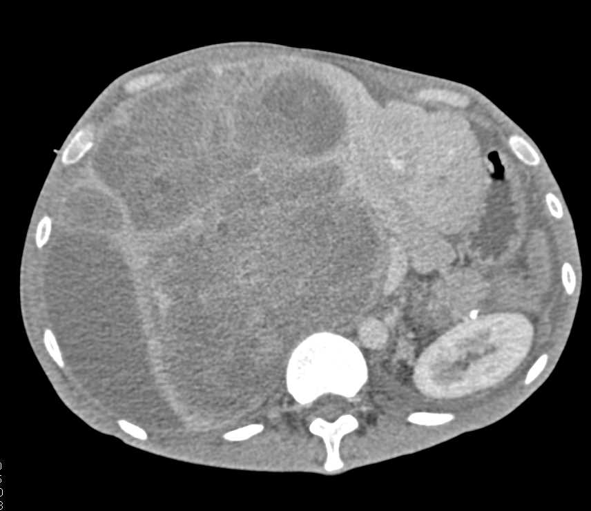 spindle cell sarcoma